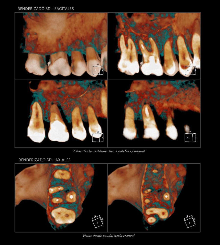 Placa CBCT con renderizado 3D